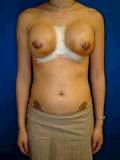 Revision Breast Surgery