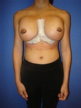 Revision Breast Surgery