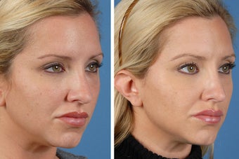 Botox Cosmetic & Restylane