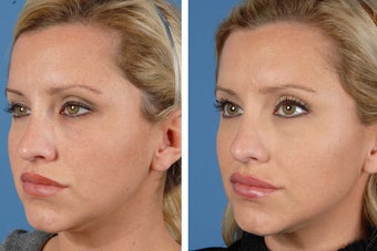 Botox Cosmetic & Restylane