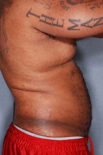 SmartLipo Breasts & Abs 