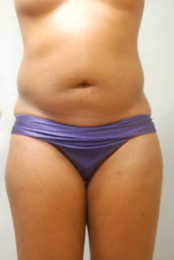 SmartLipo Abs & Love Handles 