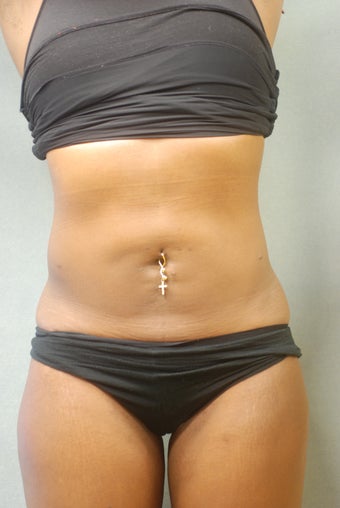 SmartLipo Abs & Love Handles 