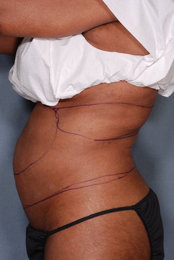 SmartLipo