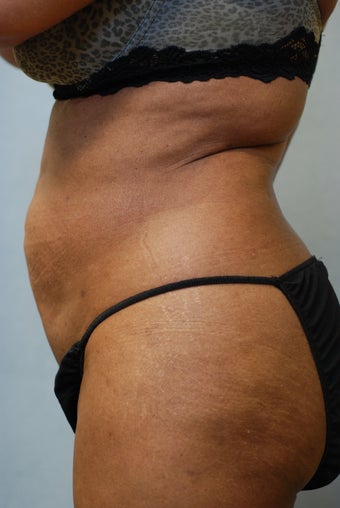 SmartLipo