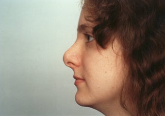 Revision Rhinoplasty