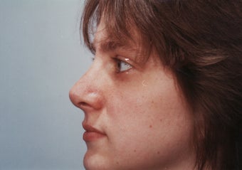 Revision Rhinoplasty