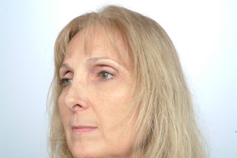 Revision Rhinoplasty