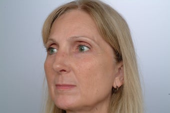 Revision Rhinoplasty