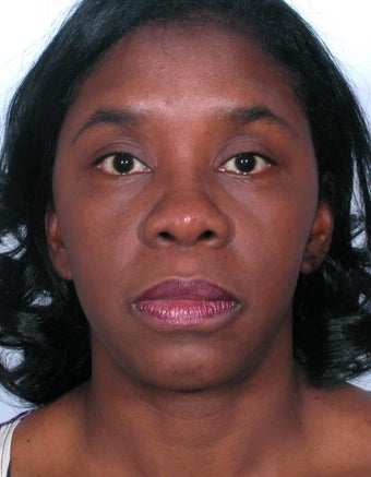 Rhinoplasty