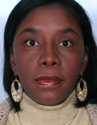 Rhinoplasty