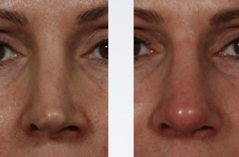 Revision Rhinoplasty