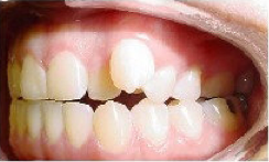 Invisalign Treatment