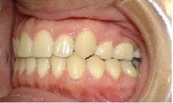 Invisalign Treatment