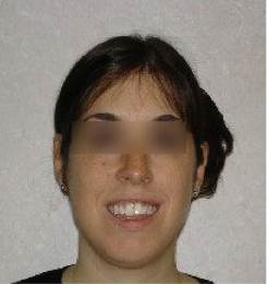 Invisalign Treatment