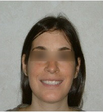 Invisalign Treatment