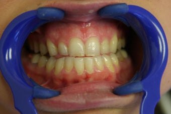 porcelain veneers