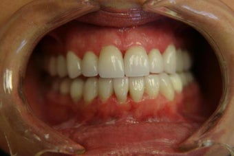 porcelain veneers