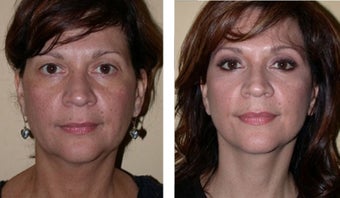 Necklift 