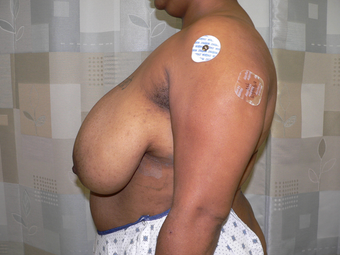 Breast reduction using the Ultimate Lift