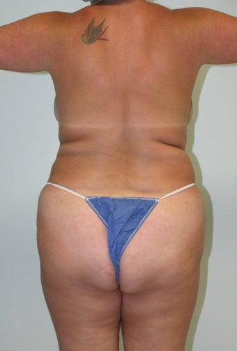 Brazilian butt lift