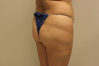 Brazilian butt lift
