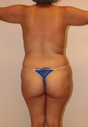 Brazilian butt lift