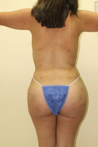 Brazilian butt lift