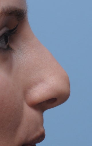 Rhinoplasty
