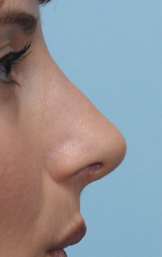 Rhinoplasty