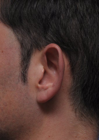 Otoplasty