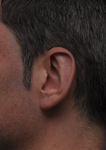 Otoplasty