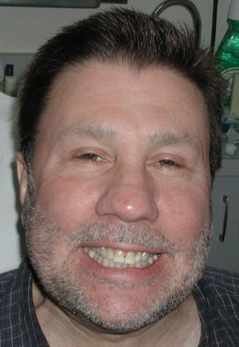 Porcelain Veneers