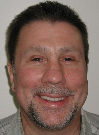 Porcelain Veneers