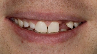 veneers and porcelain bridge 