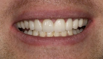veneers and porcelain bridge 