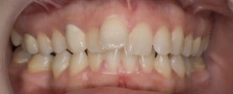 porcelain veneers