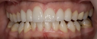 porcelain veneers