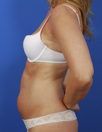 Laser Liposuction