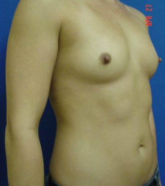 Breast Augmentation