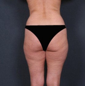 Liposuction