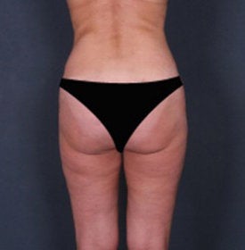 Liposuction