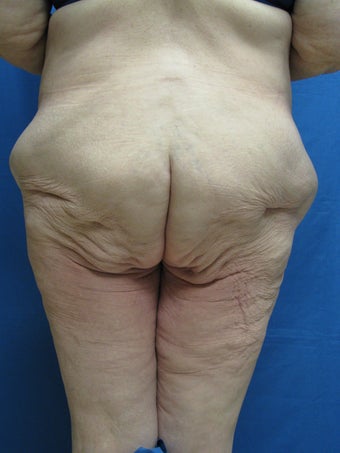 Circumferential Body Lift