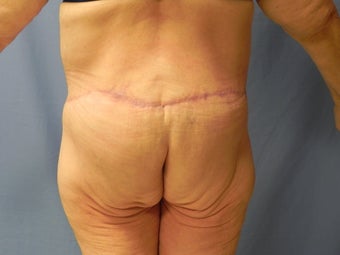 Circumferential Body Lift