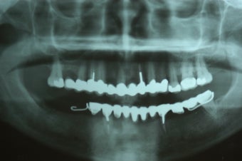 Full mouth dental implants with fixed porcelain bridge