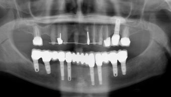 Full mouth dental implants with fixed porcelain bridge