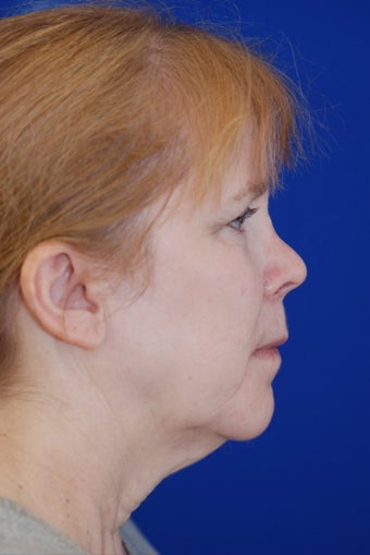 Facelift and Revision Rhinoplasty