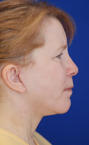 Facelift and Revision Rhinoplasty