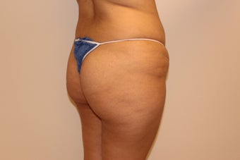 Brazilian butt lift