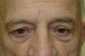 Brow lift